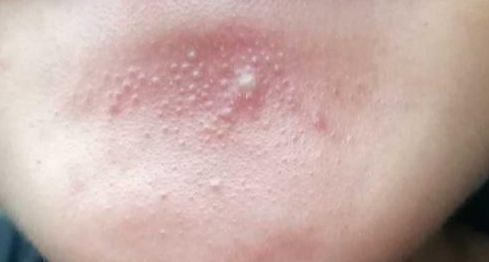 下巴出现这样的“白痘痘”要注意啦，这是螨虫的真身吗？你错了
