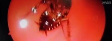 42岁女子头疼去医院，竟在颅内取出活蟑螂，医生一瞧蒙了