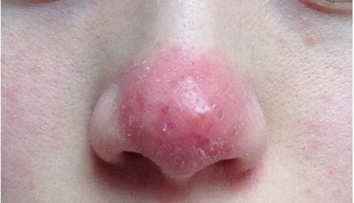 脸上经常长痘痘，那是螨虫在作怪，美容师说：螨虫不除，它会一直危害我们的皮肤