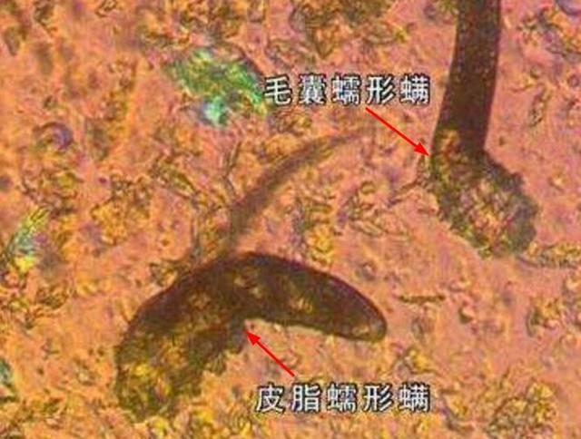 立秋后，家中螨虫繁殖增长，专家说道：卧室放一晚，螨虫连根拔除