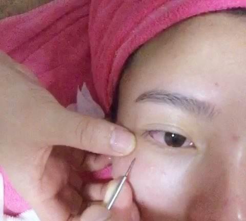 皮肤科医生说漏嘴：3个小妙招，简单不花钱，快速消灭脂肪粒