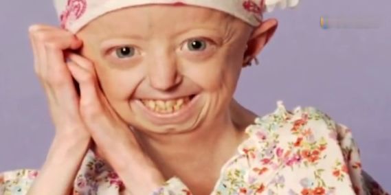 世界上老的最快的女人，19岁的年龄却拥有150岁的身体，衰老而亡