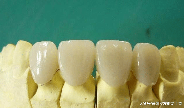 烤瓷牙的危害大吗？使用寿命能用多久？你可能还不知道