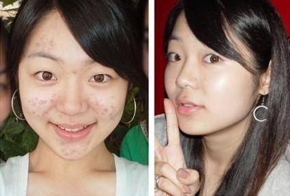 同济医学院医生：家里不起眼的“它”，抹一抹，5天痘痘全消失