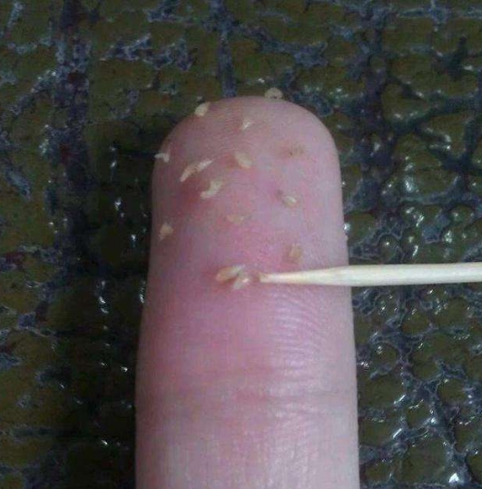 鼻子上的小疙瘩，挤出的白色物体是什么？北大医学博士说出“实情”