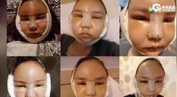 女孩砸百萬指定變楊冪，臉腫成包子！最慘是她，動刀46次變成蛇精