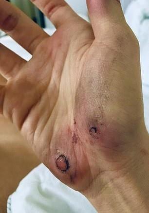“是我不够好他才打我”女模多次被男友家暴, 打到自闭仍然爱他