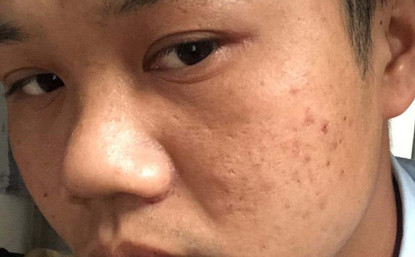 熬夜加班皮肤满是黑头，用它粉刺痘痘全搓掉，皮肤不好的男人要多用