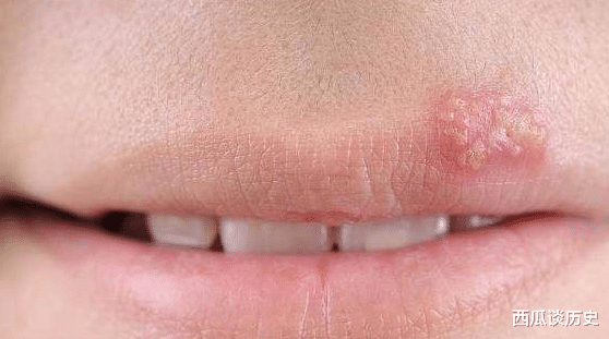 [排毒]嘴上长泡是在排毒？不，它可能暗示了这4种病