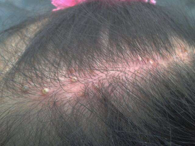 枕头5天不洗螨虫成窝，教你一土办法，一辈子都不会生螨虫！