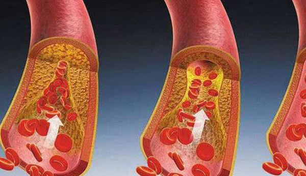 血管怕4件事，你却天天做！6分钟的血管操坚持做，血管年轻人长寿