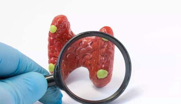 为什么女性易患甲状腺结节？患甲状腺结节，身体可能会有3个表现
