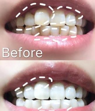 因张俪代言一小时疯卖30000支，大黄牙没了，景甜：不好用你找我