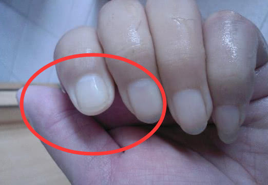 新陈代谢|肝脏是个“哑巴鬼”？手上出现“3个标记”趁早查，别等肝癌“动手”！