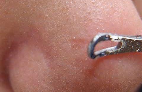 我要与你决“痘”，不再当痘女郎