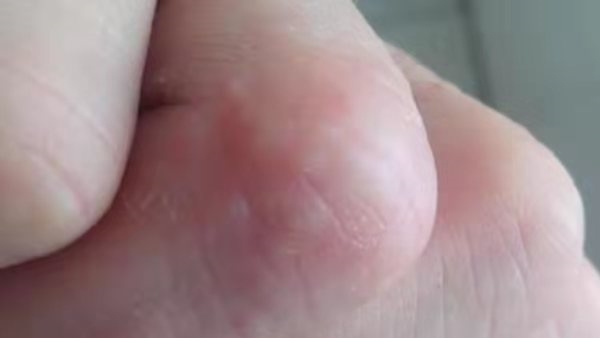 手脚长出很多“小水泡”，一抓还很痒是什么原因？幸好知道不晚