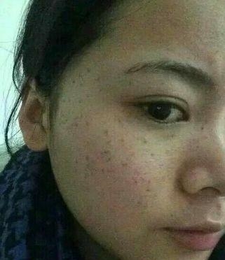 长出“老年斑”不用慌张, 教你一个土法子, 抹3次色斑根连株拔!