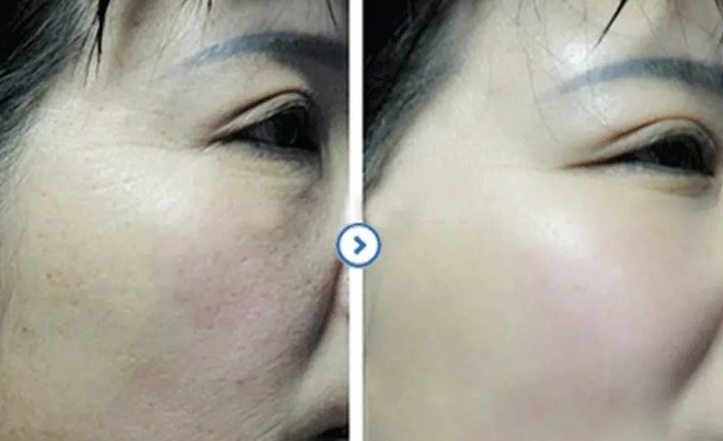 鼻子上的小疙瘩，挤出的白色物体是什么？北大医学博士说出“实情”