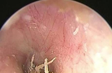 42岁女子头疼去医院，竟在颅内取出活蟑螂，医生一瞧蒙了