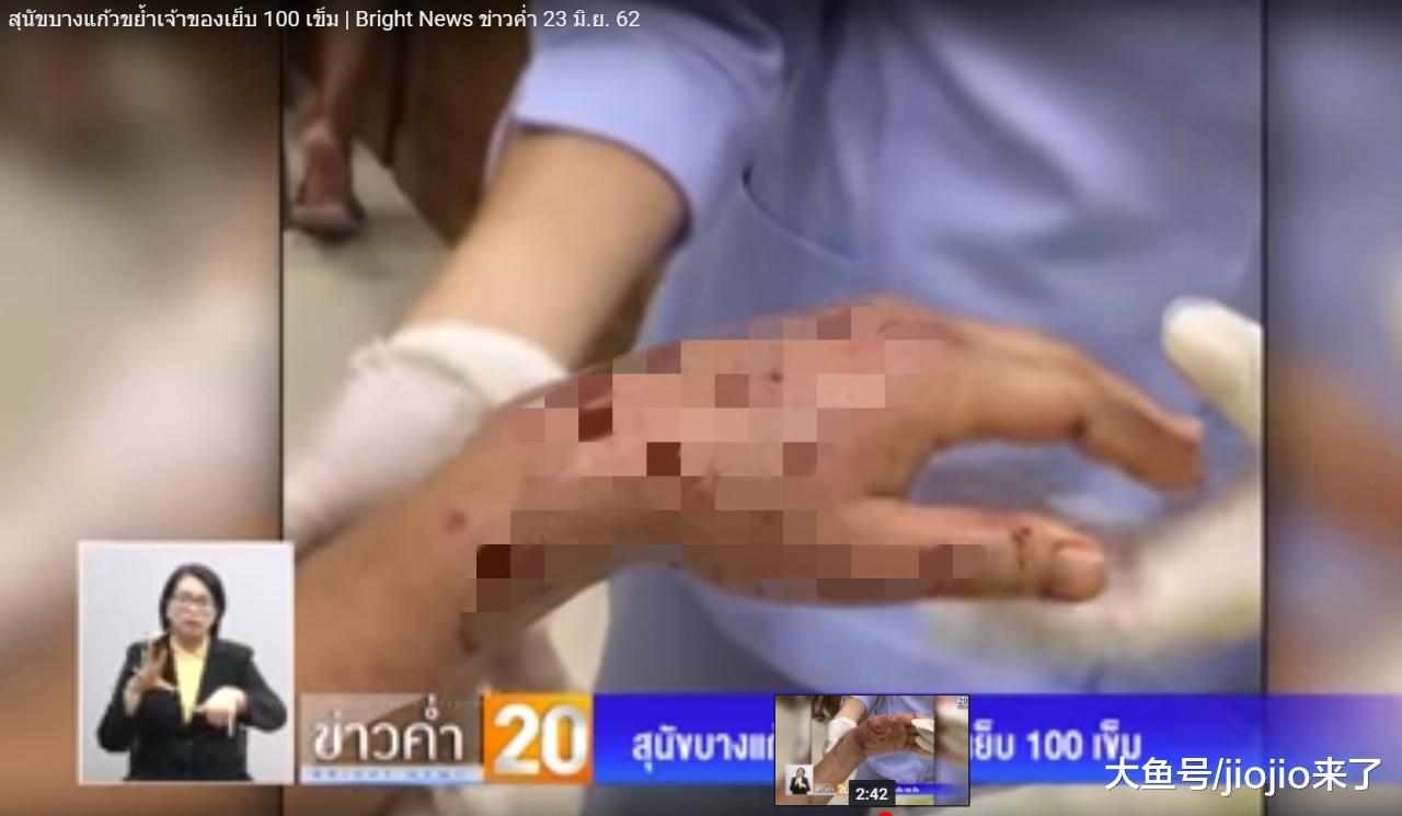 家中狗狗突然发狂，老奶奶惨被咬，伤势严重缝合近百针