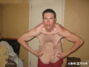 600斤男子减肥手术成功了，脱下衣服后，他的皮还可以铺一张床