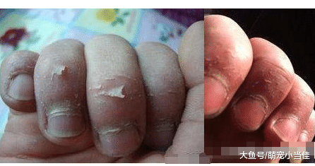 孩子有这5种表现, 已经缺锌严重, 再不补锌就来不及了家长需重视