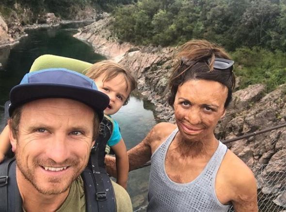 她严重烧伤，五官全无，混血男友不离不弃，捧脸颊轻吻