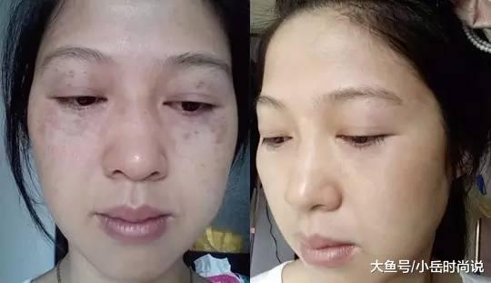 药店有一种“医用乳膏”要火了， 5次斑如雨落下， 祛斑堪比整容