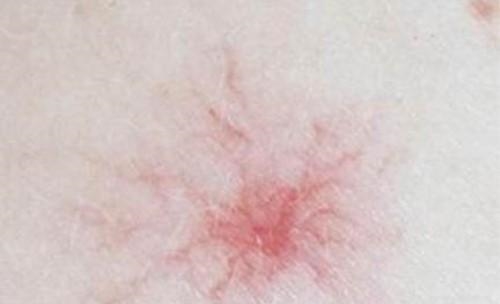 身上长了许多“小红点”, 可能是脂肪肝、肝炎、肝硬化!