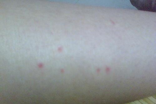 身上长了许多“小红点”, 可能是脂肪肝、肝炎、肝硬化!