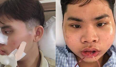 男子花4万多整容，吃1个月流食，外表满意了痛苦也值得