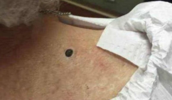 女子背上的黑痣突然又疼又痒，已经长了30年，医生拔出后女子不淡定了