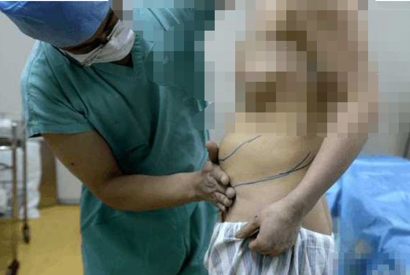 女子12年前做手术，发现硅胶不见，医院检查发现硅胶转移