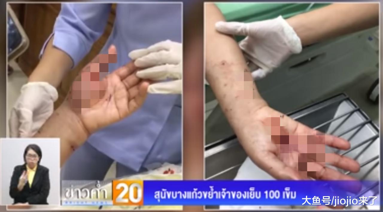 家中狗狗突然发狂，老奶奶惨被咬，伤势严重缝合近百针