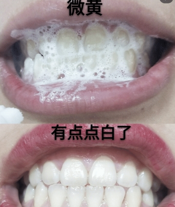 能把牙科医院整的没生意的慕斯，堪称是美牙界的一姐，网友跪服