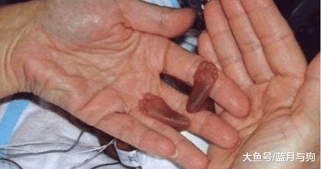 宝宝出生只有280克，世界上最小的宝宝成功存活，母亲伟大的母爱