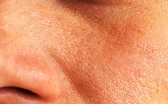 脸上螨虫超级多？教你一个土办法，不到一毛钱，螨虫全部死光光，全军覆灭