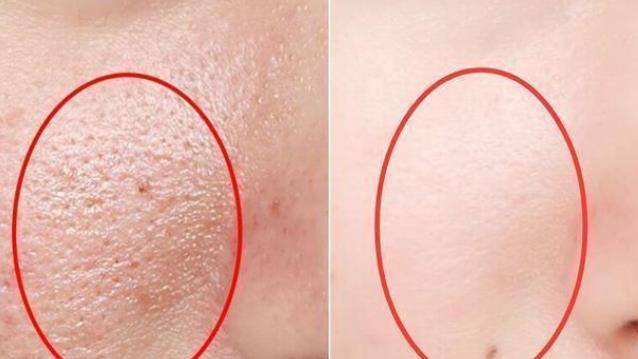 我要与你决“痘”，不再当痘女郎