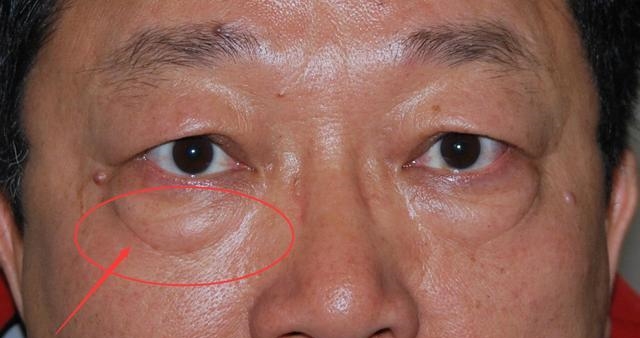 女人有眼袋贼显老, 这些消眼袋的小秘方能帮到你!