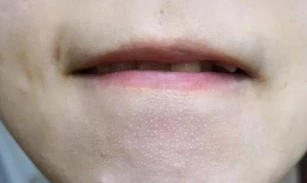 下巴鼻翼有白色“颗粒”，十个人中九人中招，你知道什么在作祟么