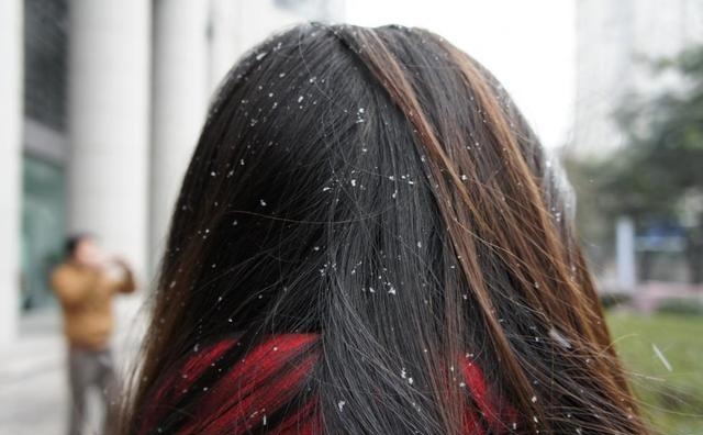 一天不洗头上就像“下雪” 水中放点它 告别头屑烦恼不反复