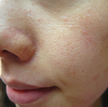 毛孔粗大特粗糙，皮肤医生教你应该小诀窍，毛孔很快收起来