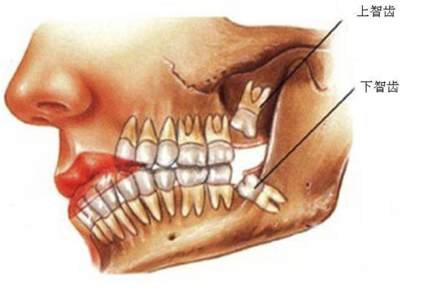 智齿是什么呢？到底要不要拔出？看完后恍然大悟