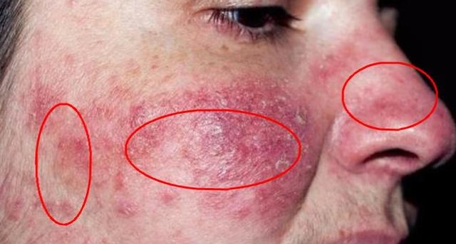 脸上螨虫超级多？教你一个土办法，不到一毛钱，螨虫全部死光光，全军覆灭