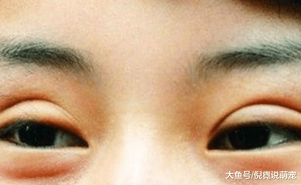 割了双眼皮的人到老了以后会有哪些变化？结果你可能想不到