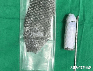 女子生来没有那个， 医生用鱼皮替其再造, 与男友成功完成“亲密行为”