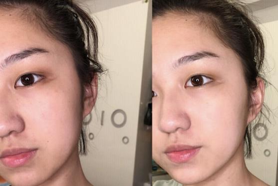 有一种乳膏，最近火爆了，搓一下黑头毛孔全消失，网友：堪比换脸