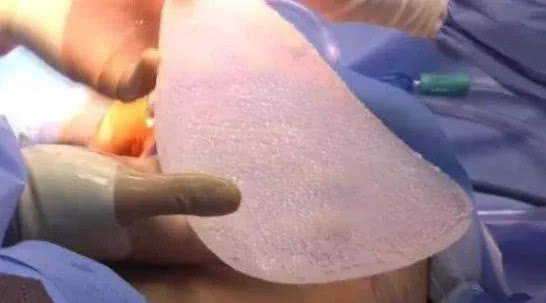 整形|还记得那个整形一百多次的男人吗？花154万给后背植入翅膀，今状况如何？