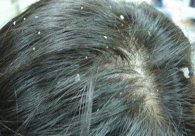 头皮发痒一抓就满手的头屑 洗头时多做一步, 让你跟头皮屑说拜拜