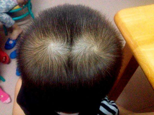 孩子头上“发旋”越多，智商就越高吗？